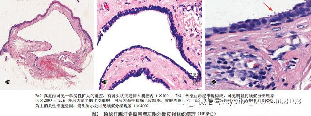 【病例报告】顶泌汗腺汗囊瘤一例