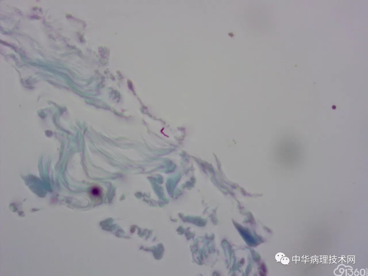 如何避免抗酸染色假阳性