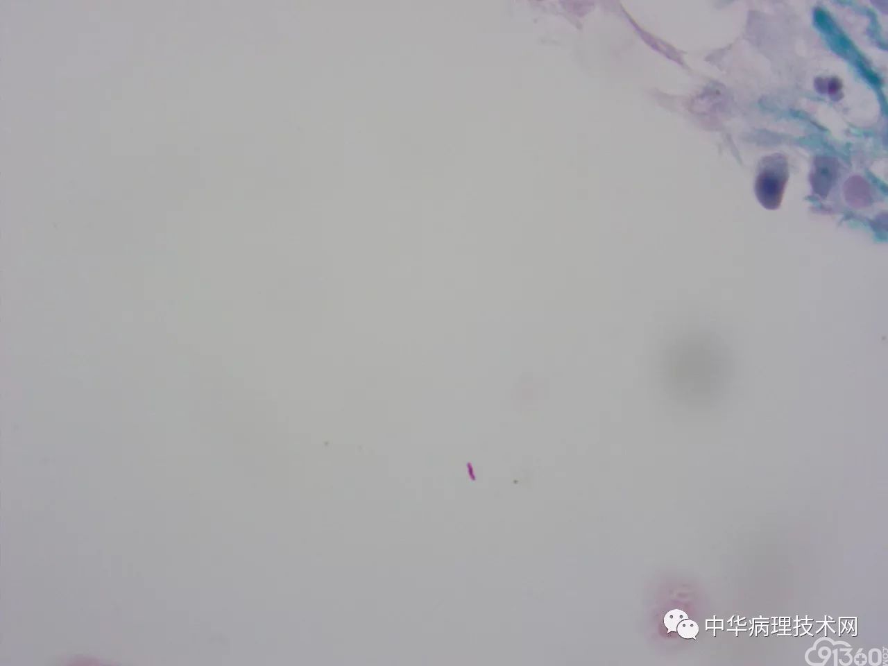 如何避免抗酸染色假阳性