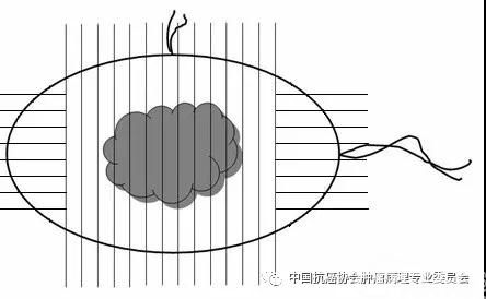 图1 垂直切缘放射状取材