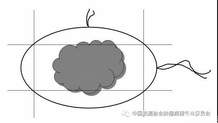 图2 切缘离断取材