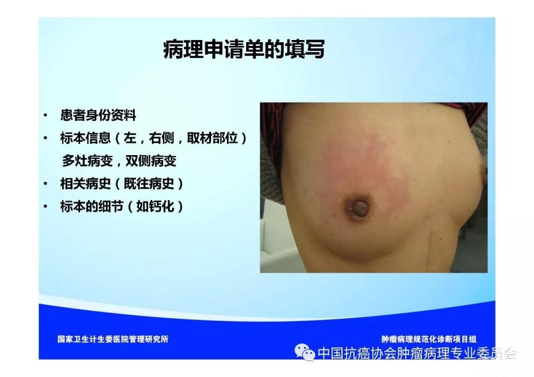 肿瘤病理规范化诊断标准 第5部分:乳腺癌病理诊断标准