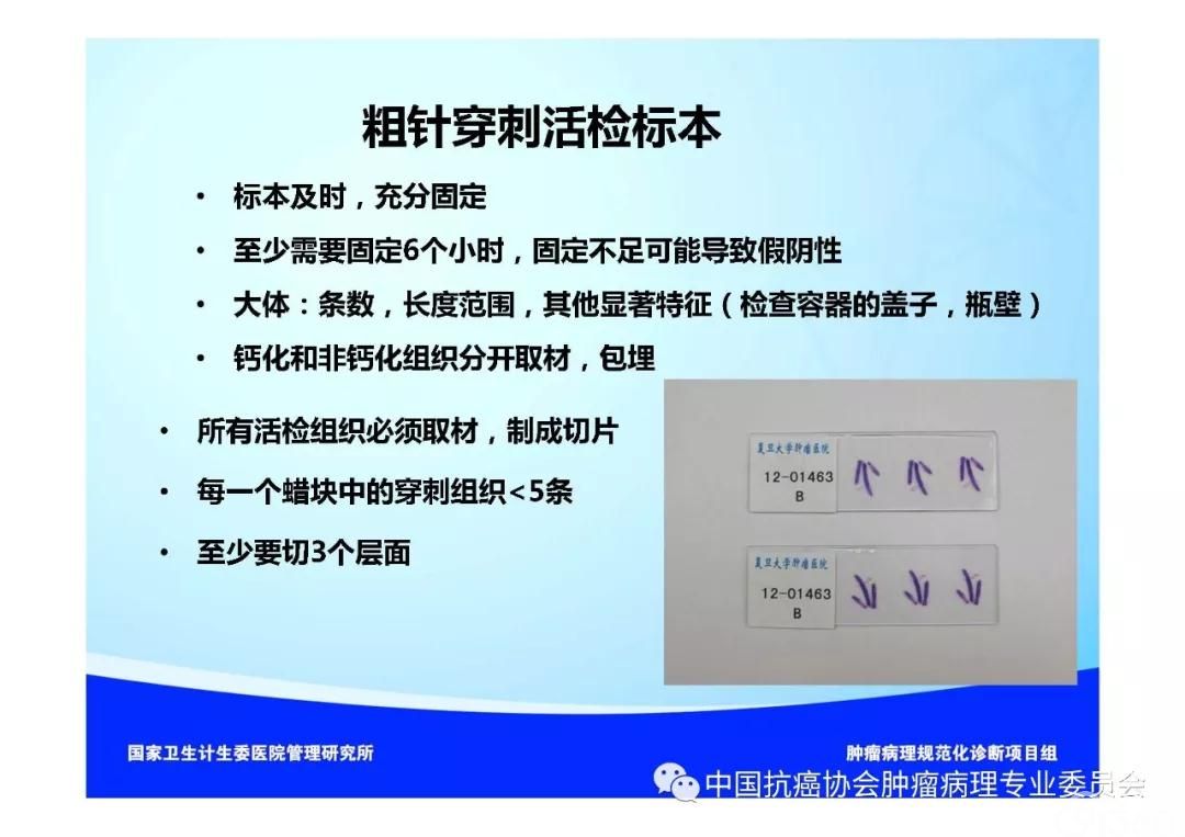肿瘤病理规范化诊断标准 第5部分:乳腺癌病理诊断标准