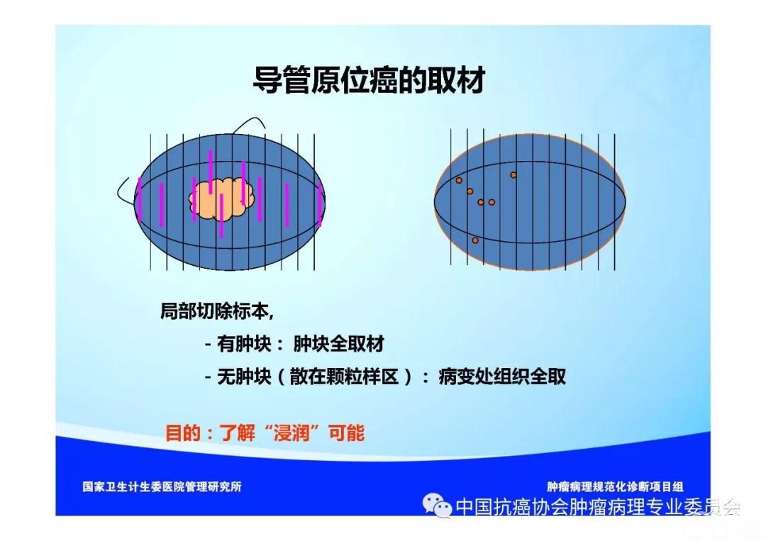 肿瘤病理规范化诊断标准 第5部分:乳腺癌病理诊断标准