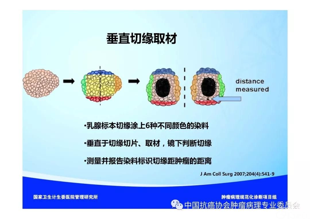 肿瘤病理规范化诊断标准 第5部分:乳腺癌病理诊断标准