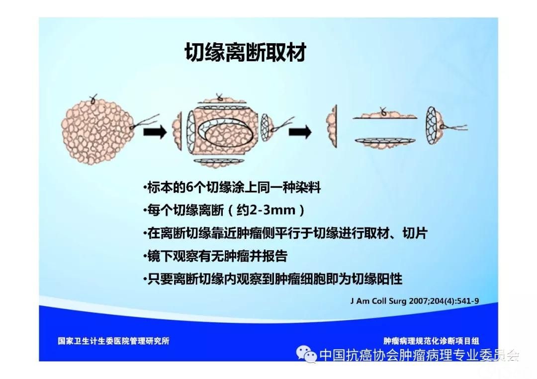 肿瘤病理规范化诊断标准 第5部分:乳腺癌病理诊断标准