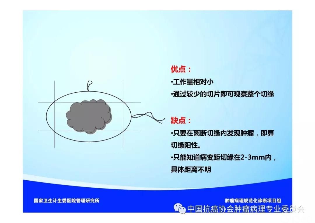 肿瘤病理规范化诊断标准 第5部分:乳腺癌病理诊断标准