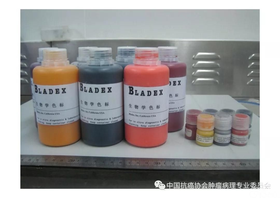 肿瘤病理规范化诊断标准 第5部分:乳腺癌病理诊断标准