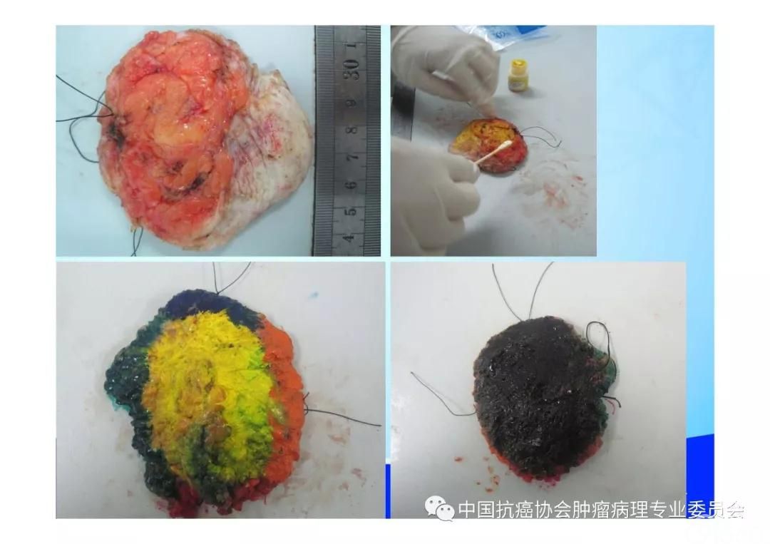 肿瘤病理规范化诊断标准 第5部分:乳腺癌病理诊断标准