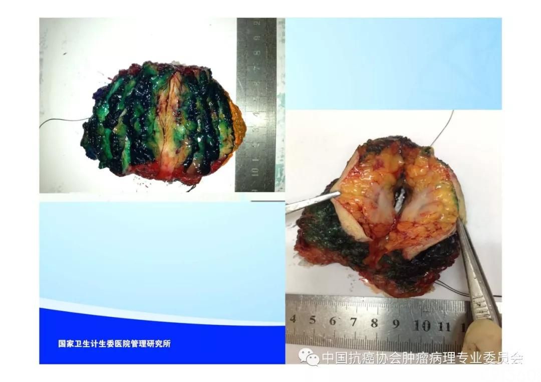 肿瘤病理规范化诊断标准 第5部分:乳腺癌病理诊断标准