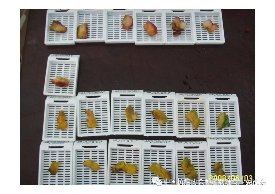 肿瘤病理规范化诊断标准 第5部分:乳腺癌病理诊断标准