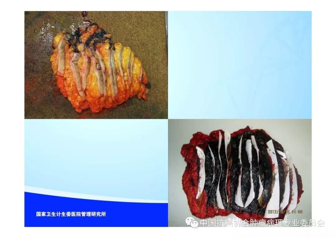 肿瘤病理规范化诊断标准 第5部分:乳腺癌病理诊断标准