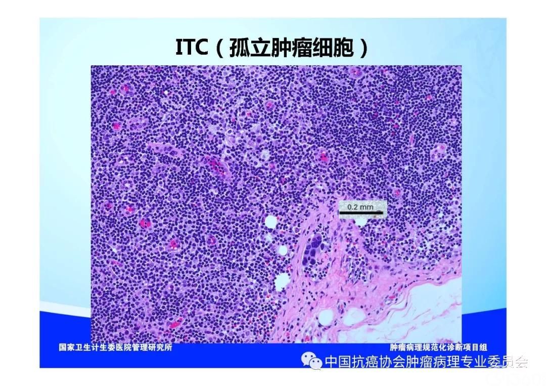 肿瘤病理规范化诊断标准 第5部分:乳腺癌病理诊断标准