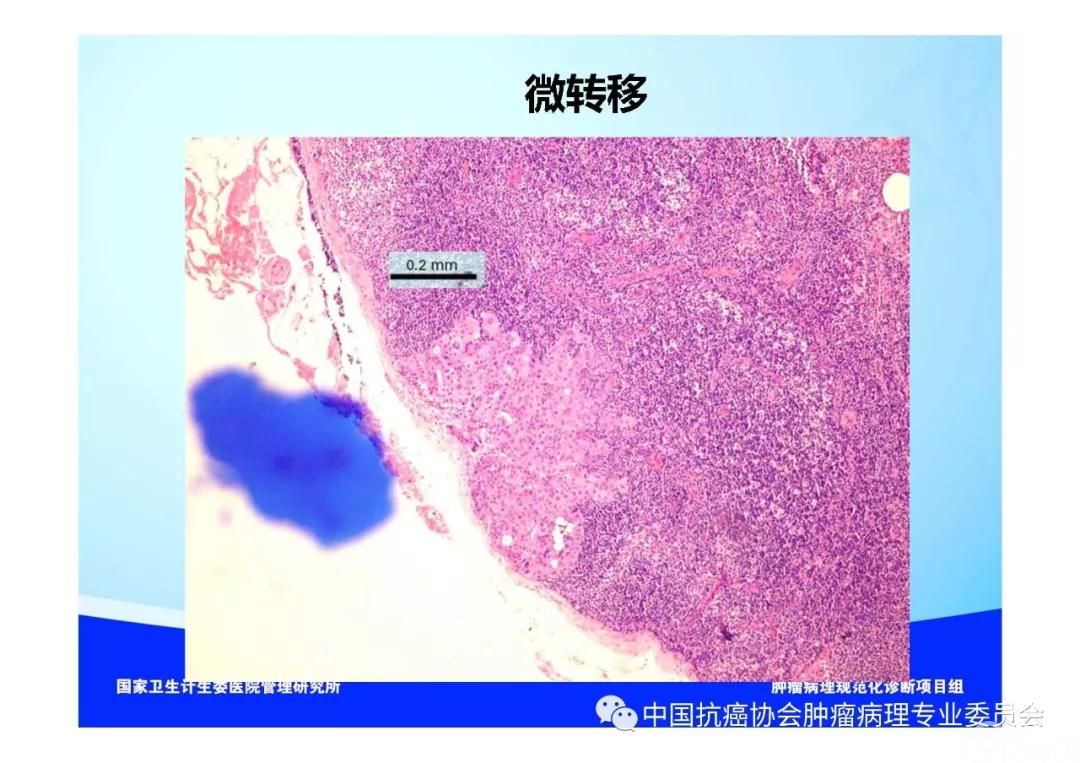 肿瘤病理规范化诊断标准 第5部分:乳腺癌病理诊断标准
