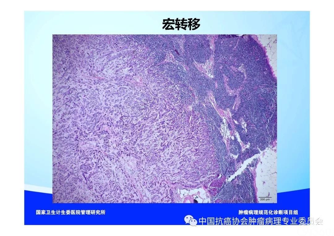 肿瘤病理规范化诊断标准 第5部分:乳腺癌病理诊断标准
