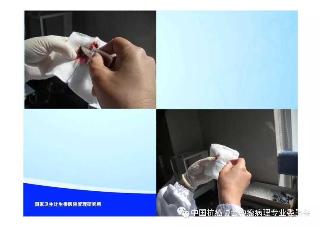 肿瘤病理规范化诊断标准 第5部分:乳腺癌病理诊断标准