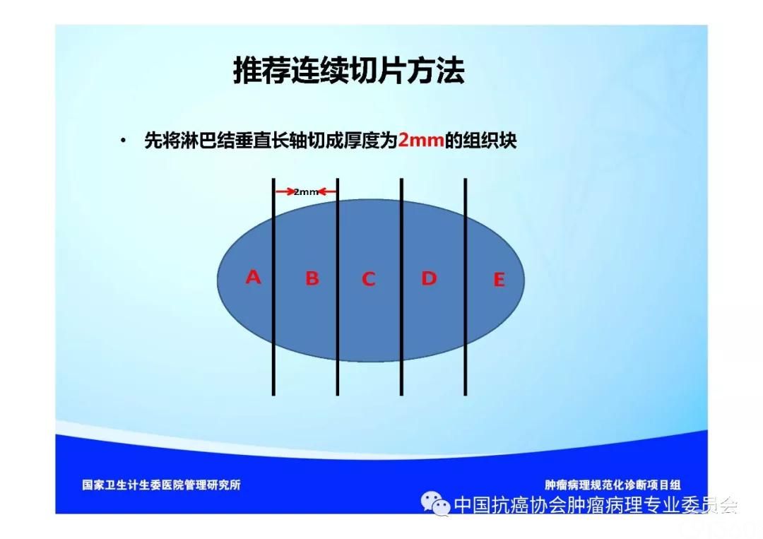 肿瘤病理规范化诊断标准 第5部分:乳腺癌病理诊断标准