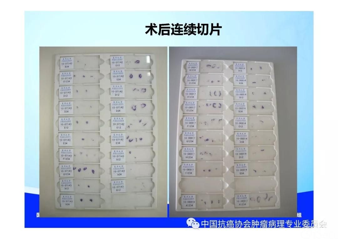 肿瘤病理规范化诊断标准 第5部分:乳腺癌病理诊断标准