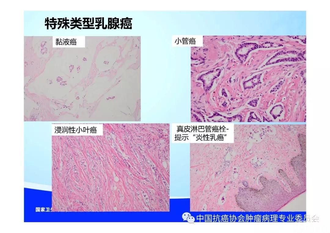 肿瘤病理规范化诊断标准 第5部分:乳腺癌病理诊断标准