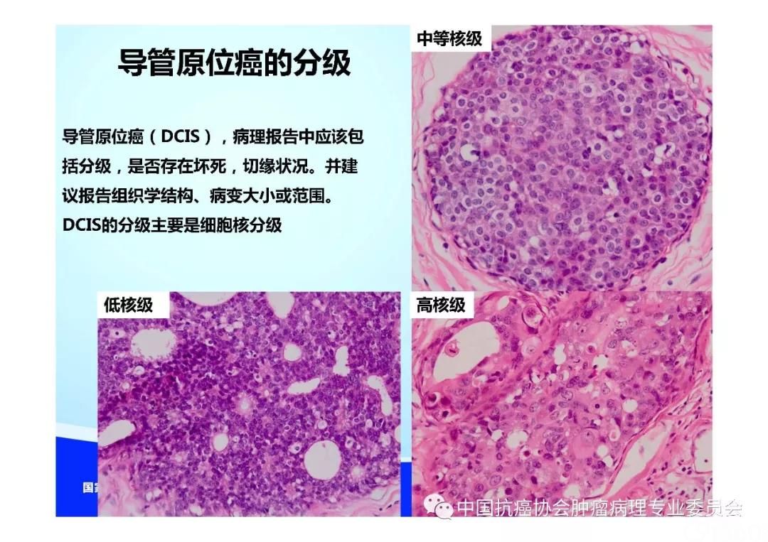 肿瘤病理规范化诊断标准 第5部分:乳腺癌病理诊断标准