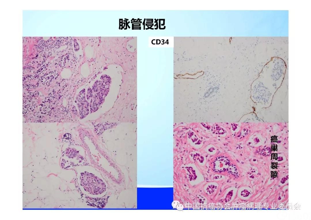 肿瘤病理规范化诊断标准 第5部分:乳腺癌病理诊断标准