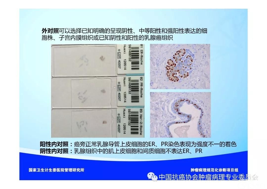 肿瘤病理规范化诊断标准 第5部分:乳腺癌病理诊断标准