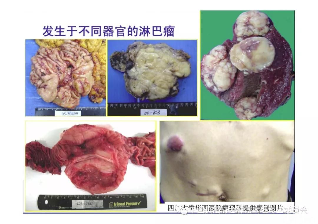 肿瘤病理规范化诊断标准 第2部分:淋巴组织肿瘤病理诊断标准