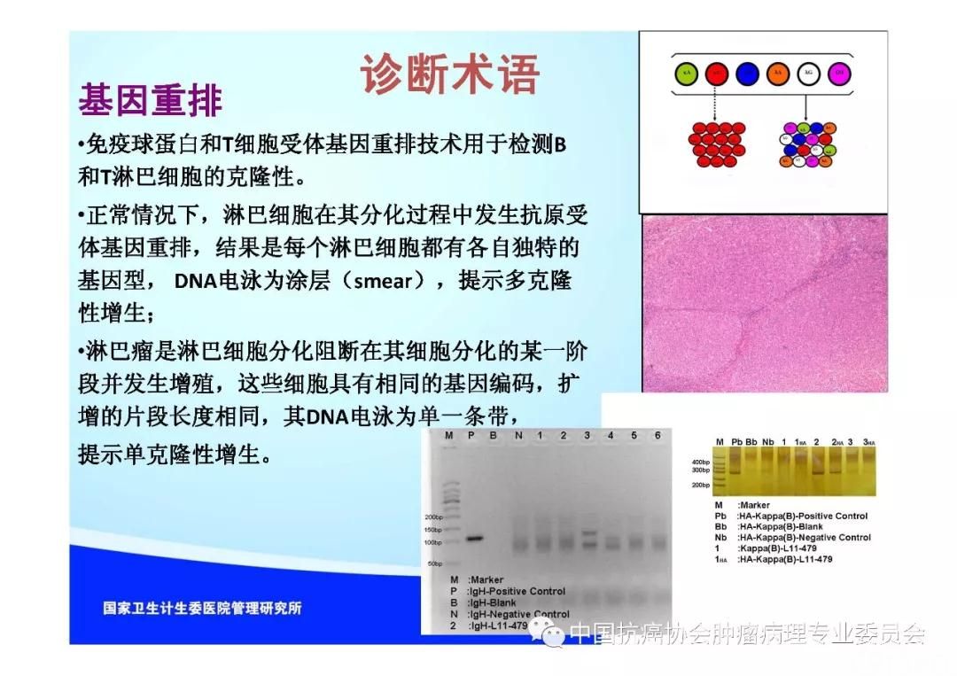 肿瘤病理规范化诊断标准 第2部分:淋巴组织肿瘤病理诊断标准