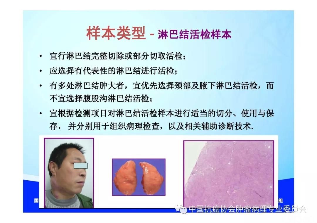 肿瘤病理规范化诊断标准 第2部分:淋巴组织肿瘤病理诊断标准