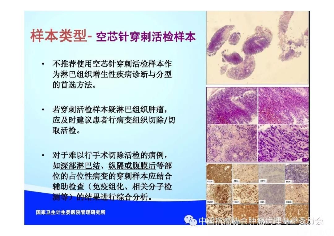 肿瘤病理规范化诊断标准 第2部分:淋巴组织肿瘤病理诊断标准