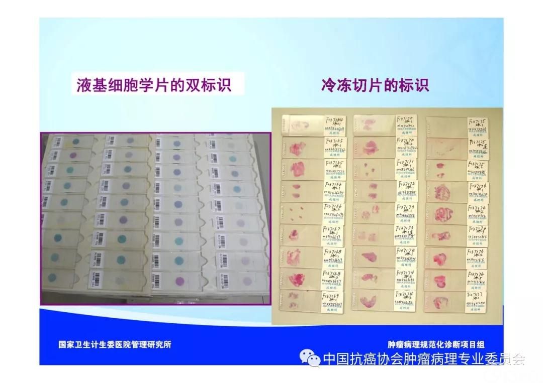 肿瘤病理规范化诊断标准 第2部分:淋巴组织肿瘤病理诊断标准