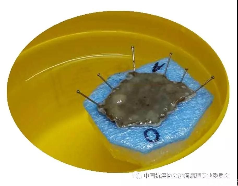 图1内镜下黏膜切除术/内镜下黏膜剥脱术标本固定示意图
