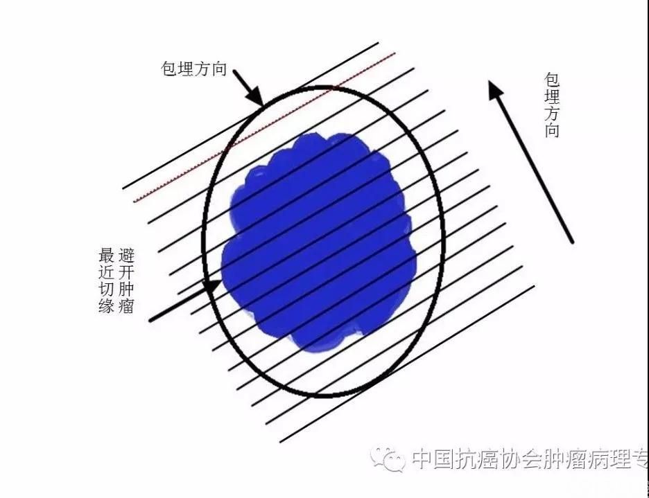 图3内镜下黏膜切除术/内镜下黏膜剥脱术标本取材示意图
