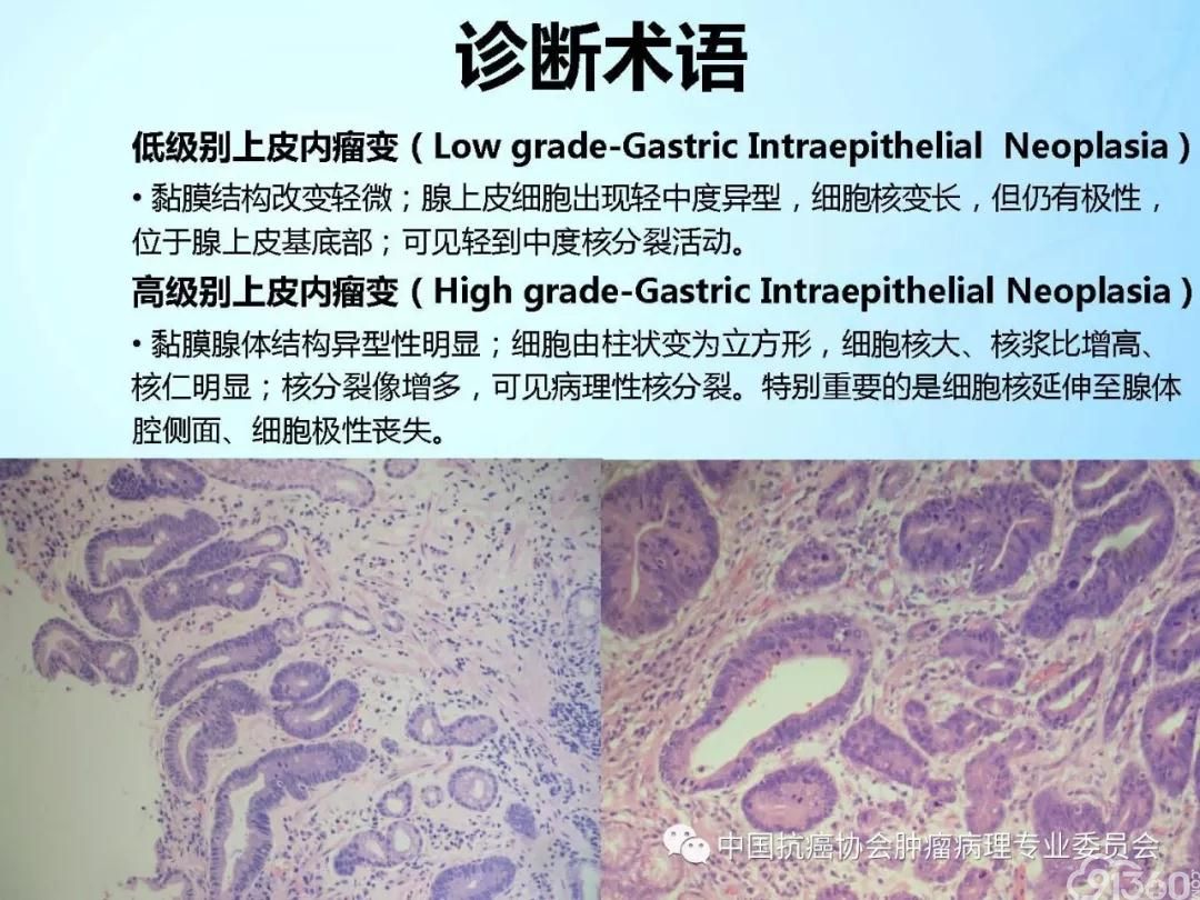 肿瘤病理规范化诊断标准 第4部分:胃癌病理诊断标准