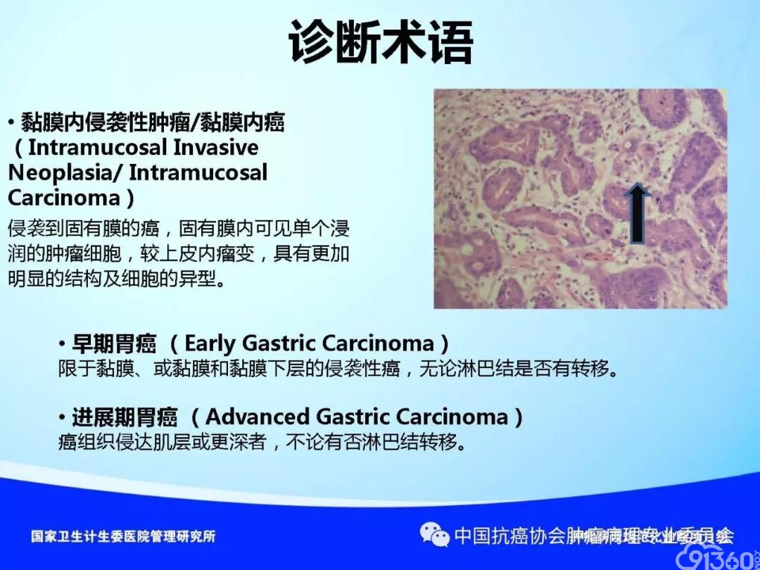 肿瘤病理规范化诊断标准 第4部分:胃癌病理诊断标准