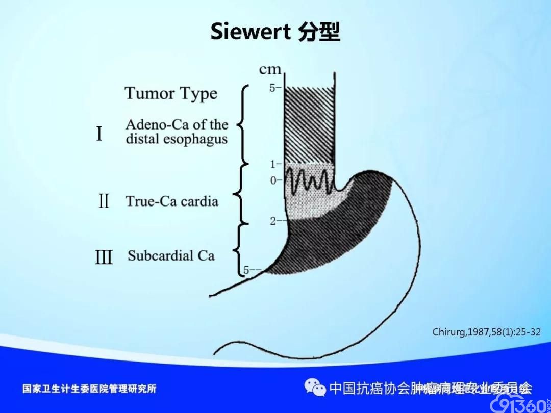 肿瘤病理规范化诊断标准 第4部分:胃癌病理诊断标准