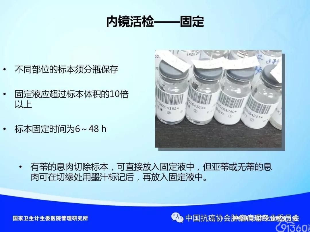 肿瘤病理规范化诊断标准 第4部分:胃癌病理诊断标准