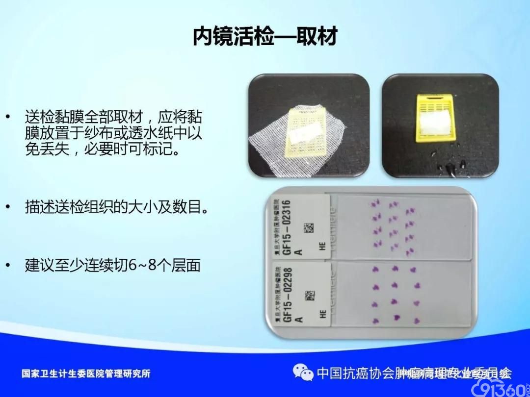 肿瘤病理规范化诊断标准 第4部分:胃癌病理诊断标准