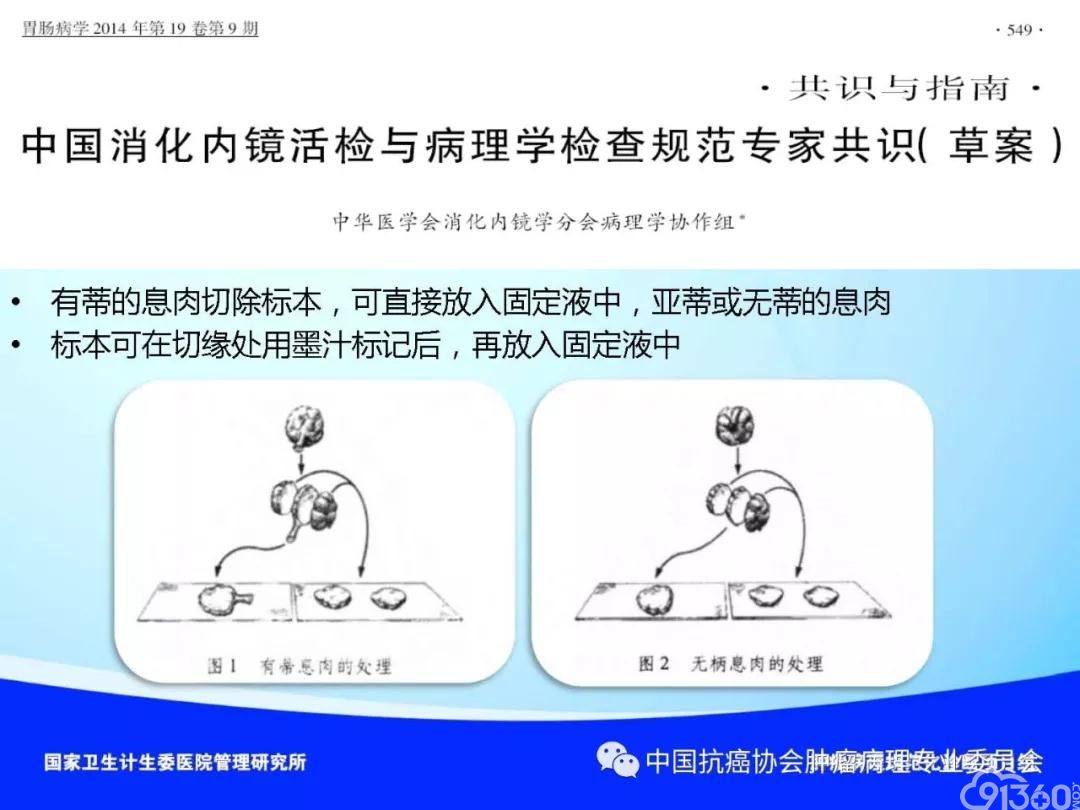 肿瘤病理规范化诊断标准 第4部分:胃癌病理诊断标准