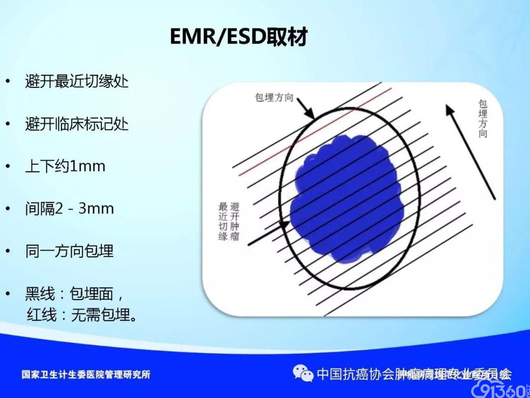 肿瘤病理规范化诊断标准 第4部分:胃癌病理诊断标准