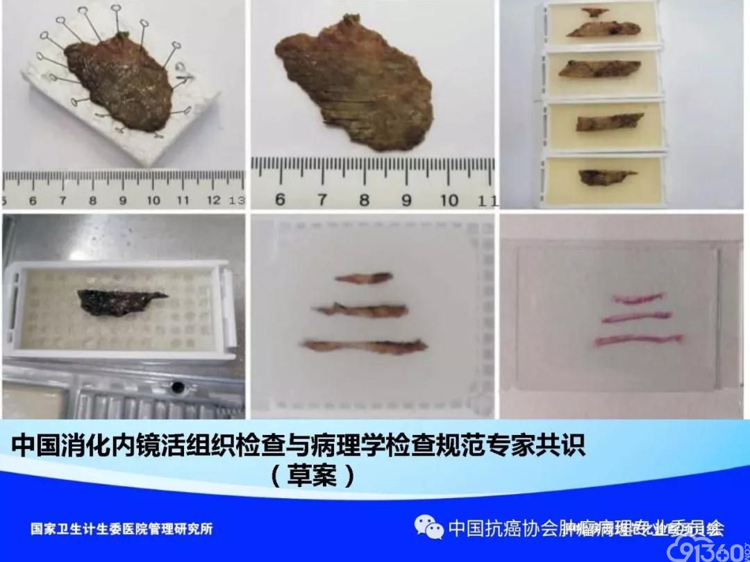 肿瘤病理规范化诊断标准 第4部分:胃癌病理诊断标准