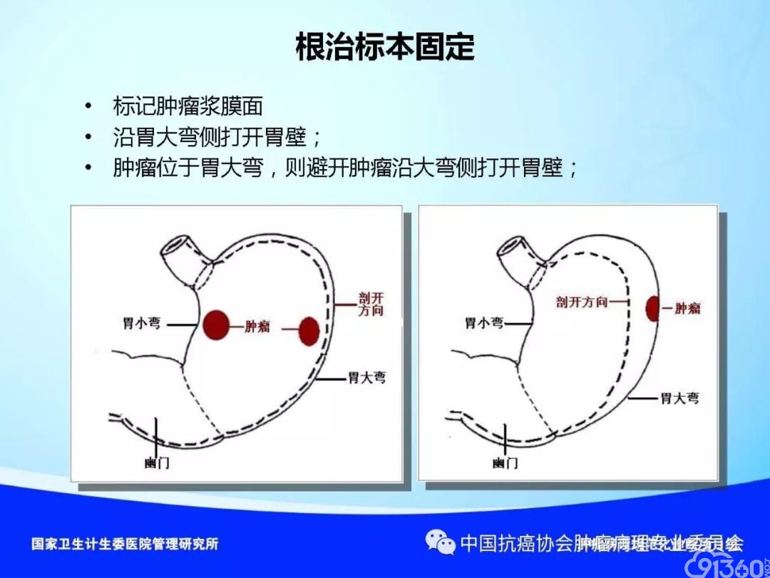 肿瘤病理规范化诊断标准 第4部分:胃癌病理诊断标准
