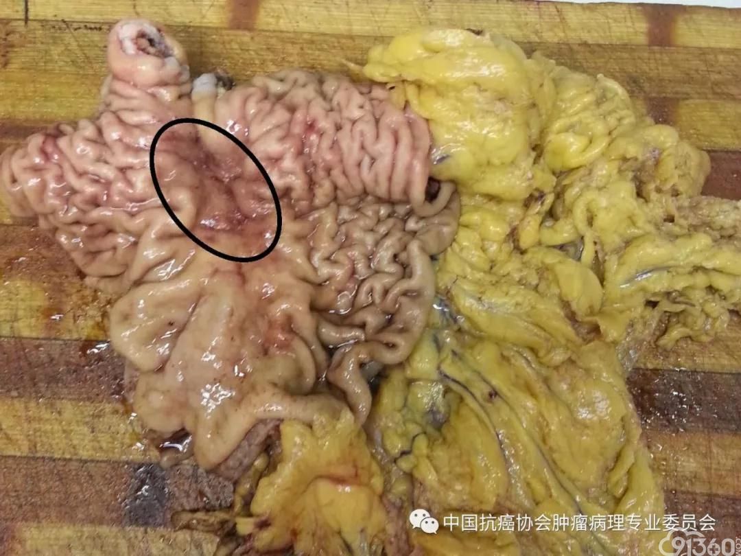 肿瘤病理规范化诊断标准 第4部分:胃癌病理诊断标准