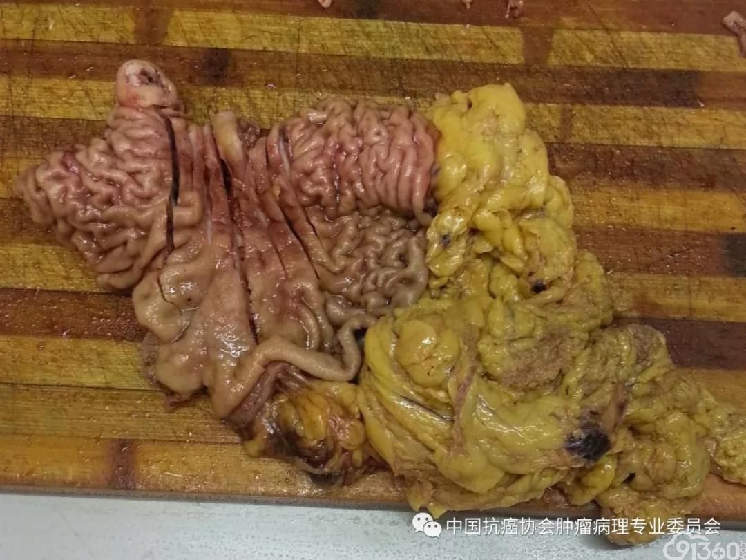 肿瘤病理规范化诊断标准 第4部分:胃癌病理诊断标准