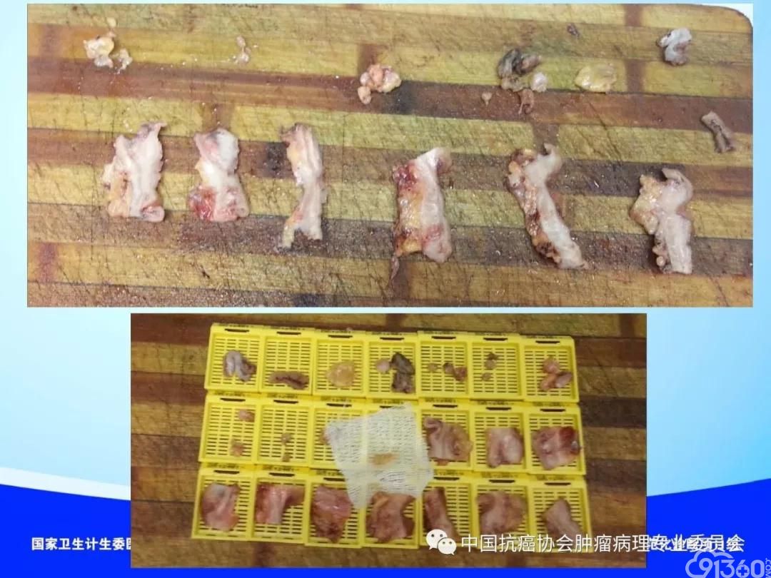 肿瘤病理规范化诊断标准 第4部分:胃癌病理诊断标准