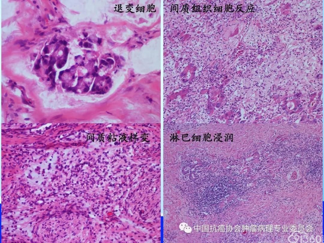 肿瘤病理规范化诊断标准 第4部分:胃癌病理诊断标准