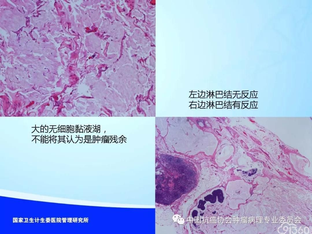 肿瘤病理规范化诊断标准 第4部分:胃癌病理诊断标准