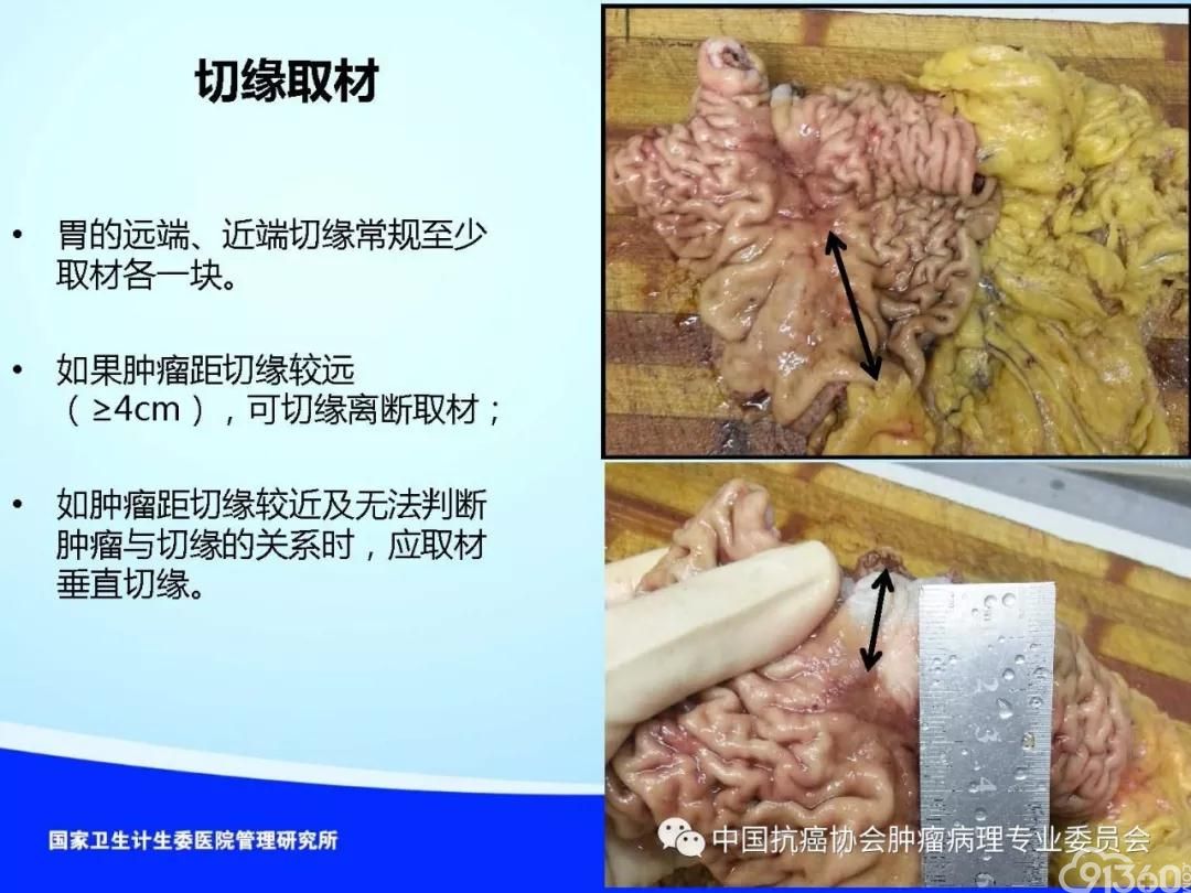 肿瘤病理规范化诊断标准 第4部分:胃癌病理诊断标准