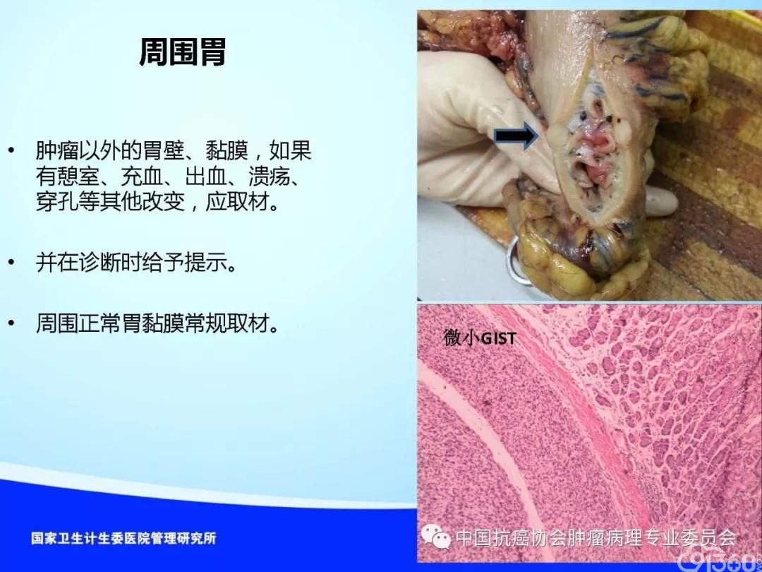 肿瘤病理规范化诊断标准 第4部分:胃癌病理诊断标准