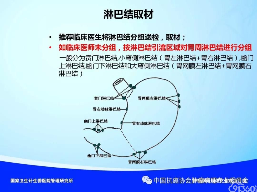 肿瘤病理规范化诊断标准 第4部分:胃癌病理诊断标准